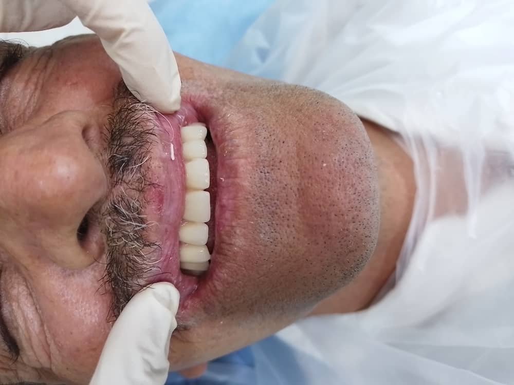 اکس پلنتیشین وایمپلنت مجدد
